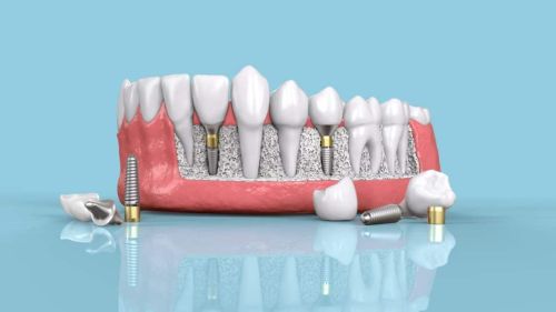 Trồng Răng Implant